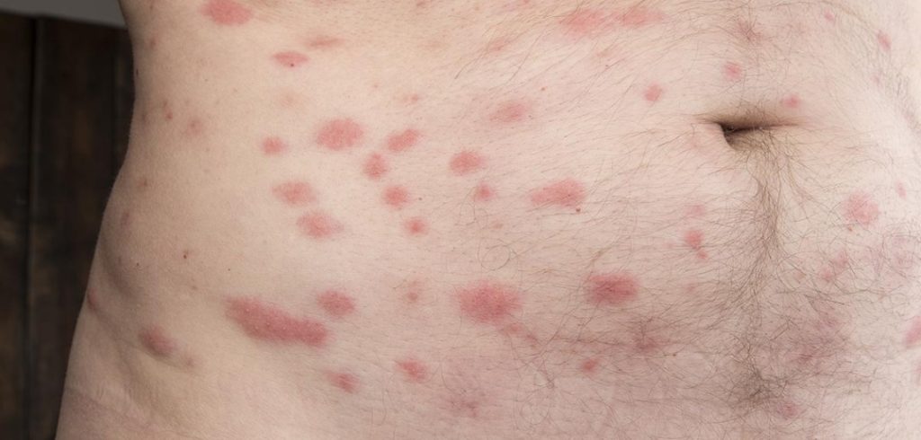 picture of flea bites on human body