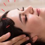 Acupuncture for Hair Loss: Is it Effective?