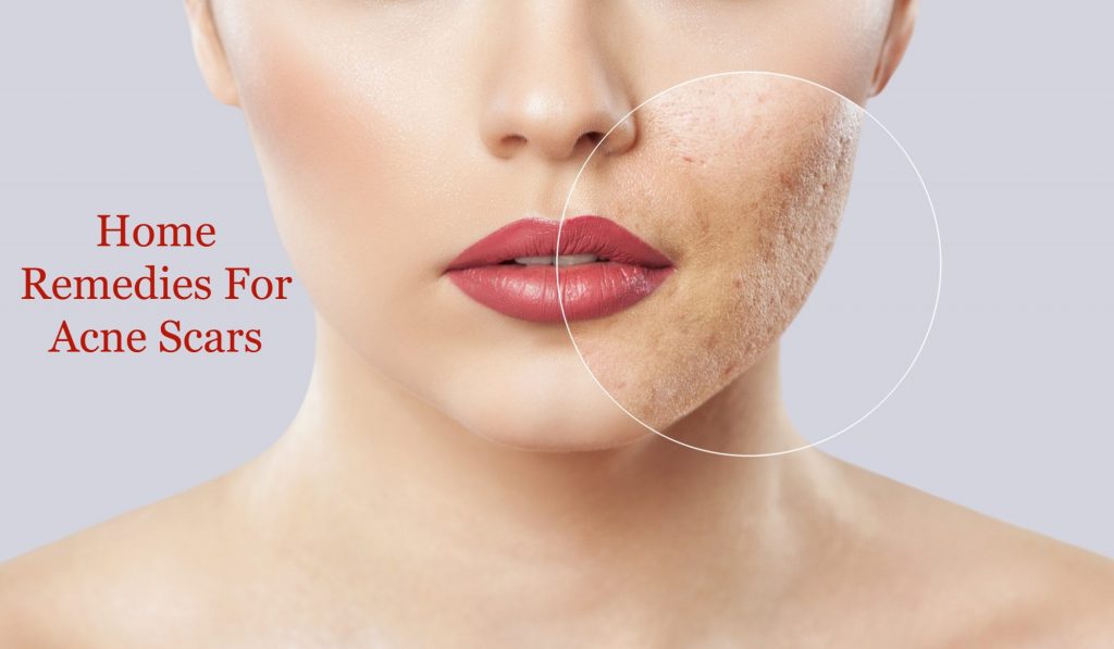 Home Remedies For Acne Scars