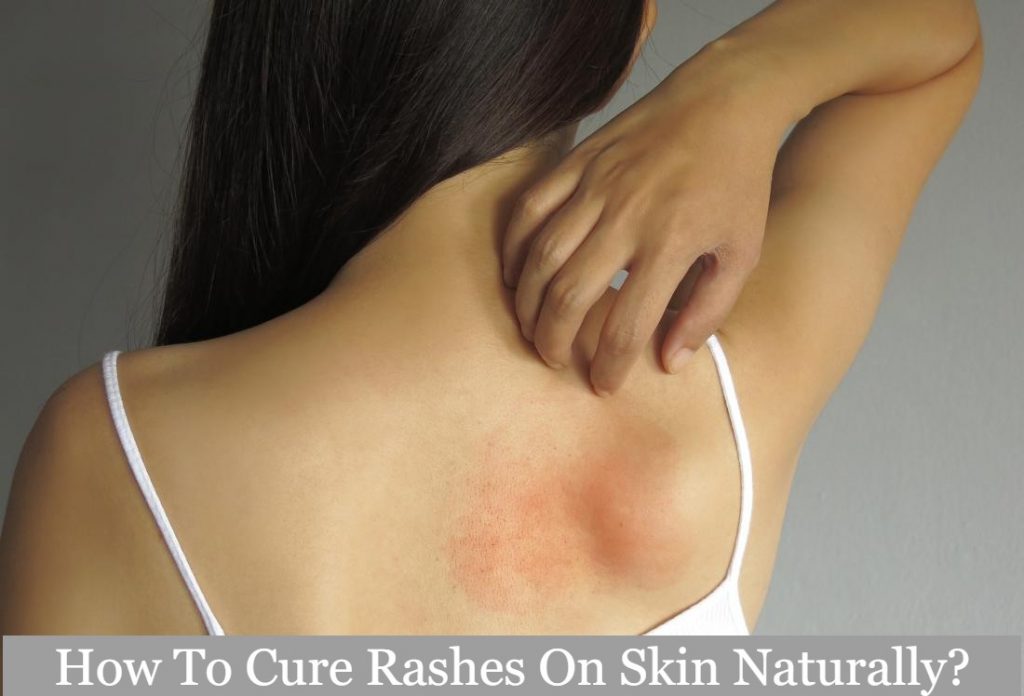 How To Cure Rashes On Skin Naturally