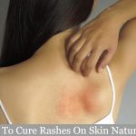 Home Remedies for Rashes: You Can Try Today