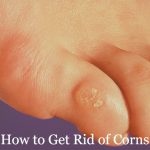 How to Get Rid of Corns: 12 Home Remedies