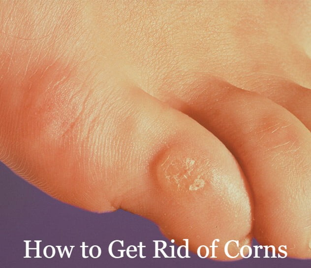 How to Get Rid of Corns