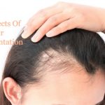 Side Effects Of Hair Transplantation