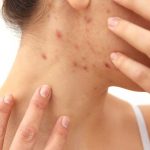 Home Remedies for Scabies