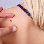 How to Get Rid of Skin Tags?