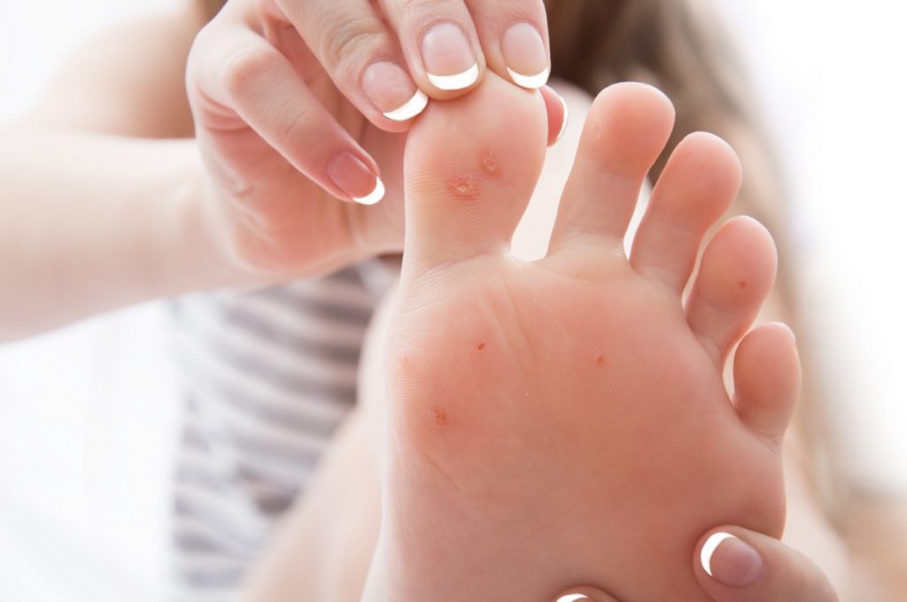 How to Get Rid of Warts