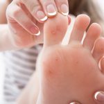 How to Get Rid of Warts : 8 Home Remedies